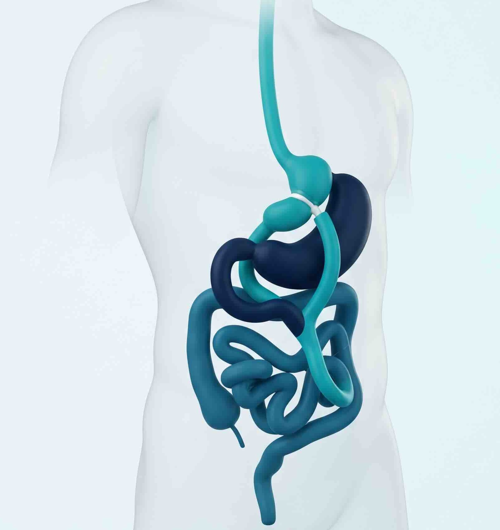 Bypass gastrique — guide visuel