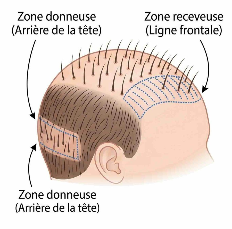 Guide visuel greffe FUE