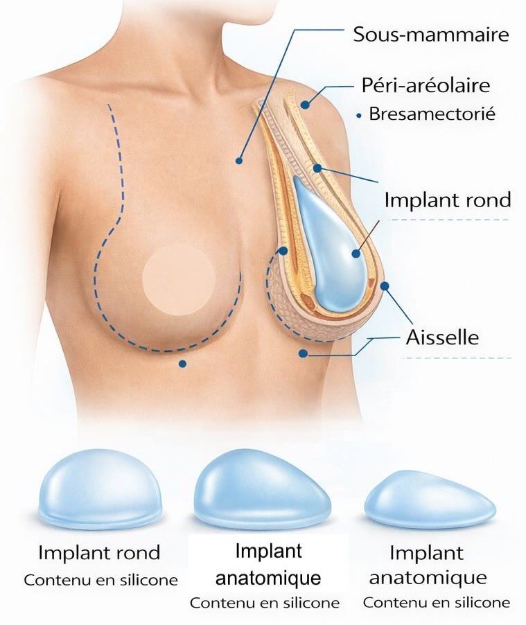 Chirurgie mammaire — guide visuel